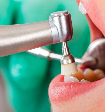 Qué es la limpieza dental con ultrasonidos?